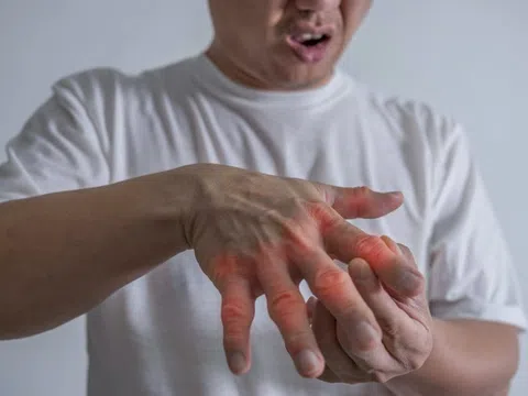 Bệnh gout dễ tái phát, lưu ý những dấu hiệu phải khám sớm