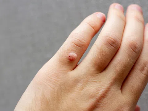Dấu hiệu trên da cảnh báo bệnh truyền nhiễm nguy hiểm