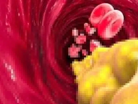Triglyceride máu cao cũng làm tăng nguy cơ đột quỵ và bệnh tim