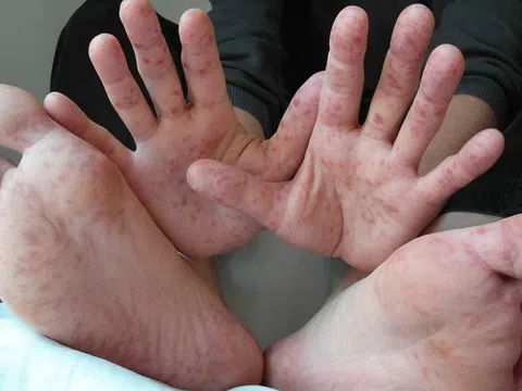 Dấu hiệu nhận biết trẻ mắc bệnh tay chân miệng