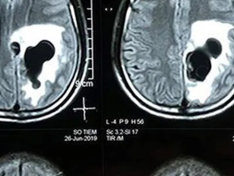 Méo miệng vì sán làm tổ trong não: Nguyên nhân từ món ăn khoái khẩu của người Việt