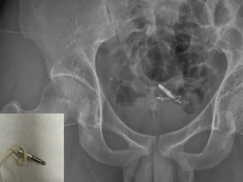 Nam sinh nhập viện vì nhét jack cắm tai nghe vào 'cậu nhỏ'