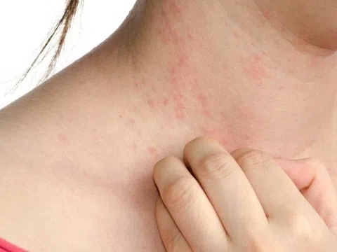 Bệnh nào dễ mắc trong mùa xuân?