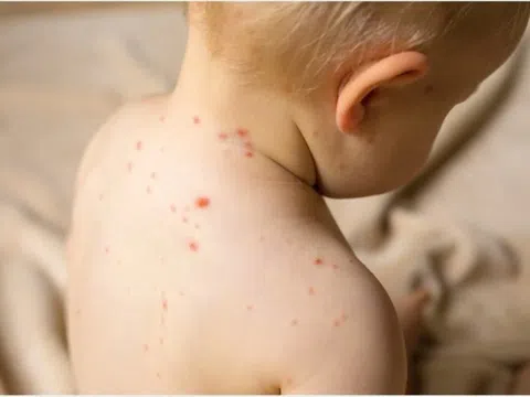 Trẻ bị sởi nên ăn gì, kiêng gì?