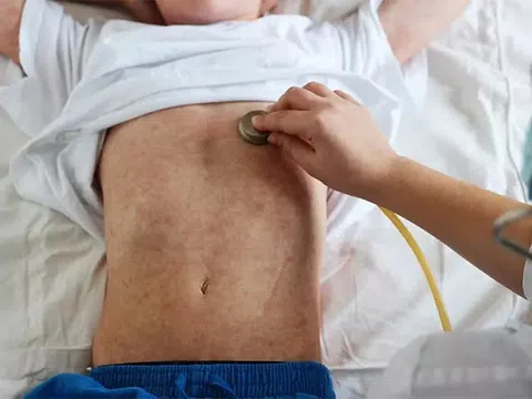 Bệnh sởi gia tăng, chăm sóc đúng cách trẻ mắc sởi tại nhà
