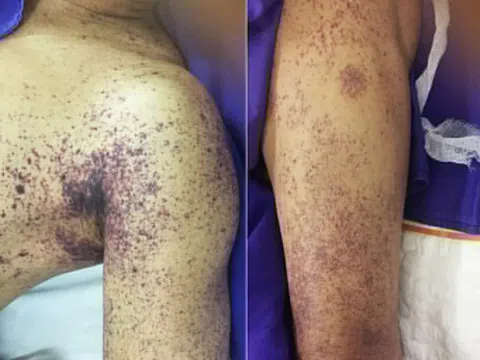 Gánh hậu quả vì thường xuyên ăn tiết canh, đồ tái sống