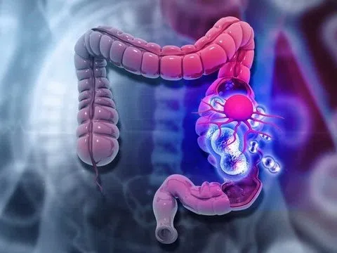 Một bệnh ung thư đang trẻ hóa, số ca tăng lên từng ngày