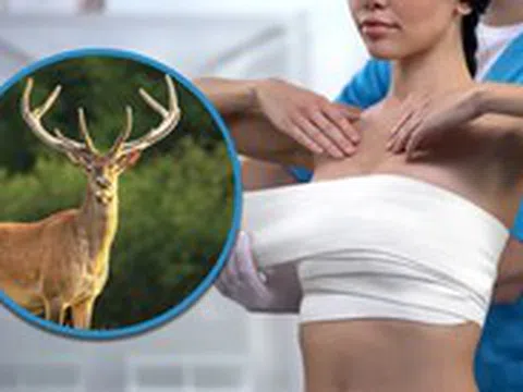 Chi 8,5 tỉ nâng ngực, cô gái tàn tật vì túi độn chứa DNA động vật