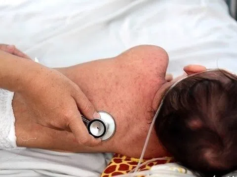 Bệnh sởi có thuốc điều trị đặc hiệu không?