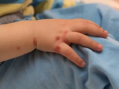 Bạn có thể mắc thủy đậu 2 lần?