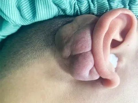 Giải cứu vành tai cho nam thanh niên 22 tuổi mắc ung thư