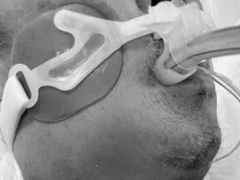 Sai lầm khi tự chữa đau răng khiến người đàn ông suy đa tạng