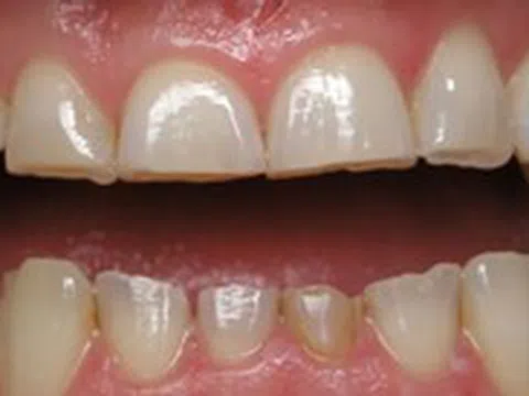 Tật nghiến răng có nguy hiểm?