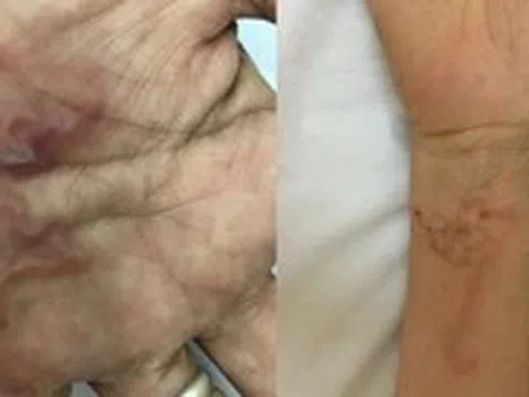Ghi nhận ca bệnh 'giun rồng' ở Việt Nam, loại giun dài đến hàng mét