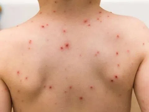 Bệnh sởi có thể bị mấy lần trong đời, làm sao để phòng ngừa?