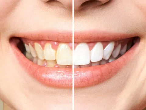 Răng ố vàng làm sao cho trắng?