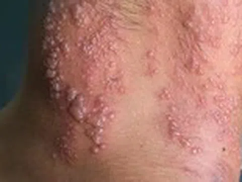 Biến chứng nguy hiểm của zona thần kinh, bác sĩ cảnh báo điều ai cũng cần biết