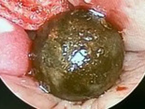 Viên đạn súng bắn chim bị 'quên' trong hốc mũi bé trai