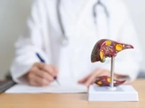 Gan nhiễm mỡ làm tăng nguy cơ ung thư, dấu hiệu nào nhận biết sớm?
