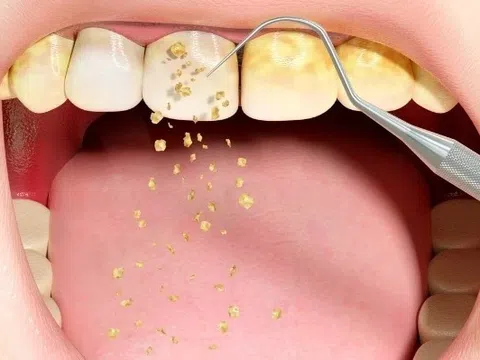'Thủ phạm' gây hôi miệng