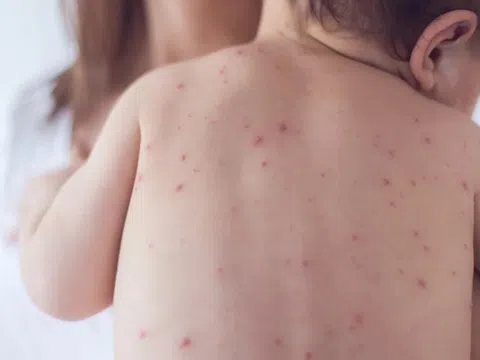 Hai loại thuốc không nên cho trẻ uống khi bị thủy đậu