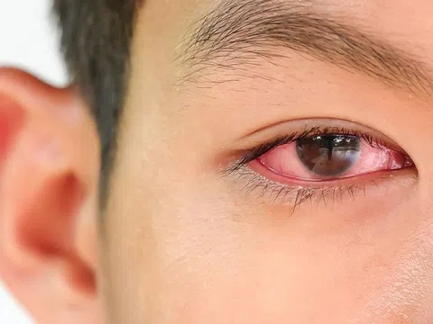 Dấu hiệu chứng tỏ bạn đang bị đau mắt đỏ