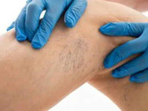 Nhân viên y tế dễ mắc suy giãn tĩnh mạch
