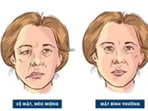 Nhiễm lạnh, trúng gió: Nguy cơ dẫn đến liệt dây thần kinh số 7 ngoại biên