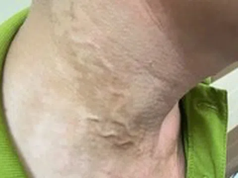 Lại phát hiện ca mắc giun rồng ở Phú Thọ
