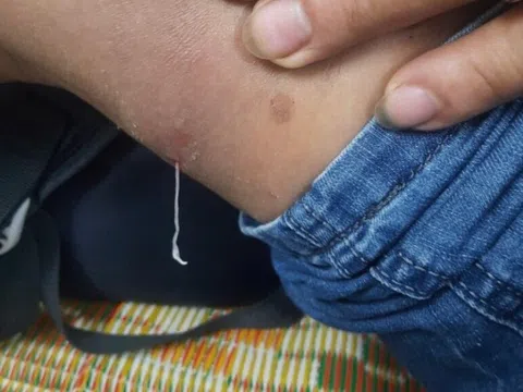 Những dấu hiệu khi nhiễm giun rồng