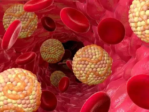 Căn bệnh âm thầm từ bữa ăn, nhiều người Việt đang mắc