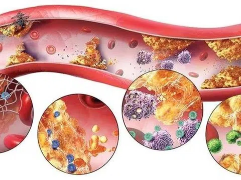 7 triệu chứng cảnh báo bạn mắc rối loạn mỡ máu