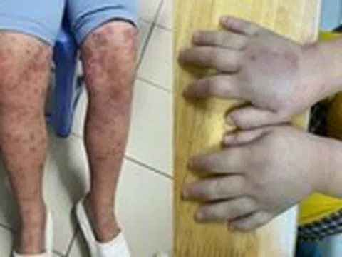 Cảnh báo bệnh ban xuất huyết Schonlein - Henoch gây biến chứng thận nguy hiểm ở trẻ em