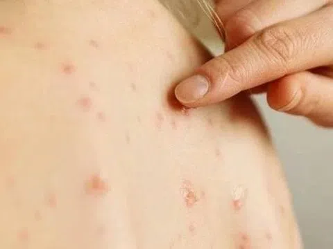 5 điều cần biết về bệnh thủy đậu