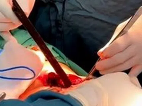 Thanh gỗ đâm xuyên ngực gần 1 gang tay, nam thanh niên thoát chết kỳ diệu