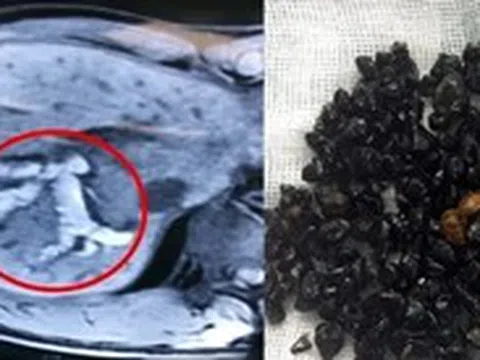 Ký sinh trùng chui lên đường mật nguy hiểm ra sao?