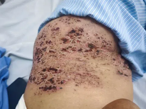 Zona thần kinh gây đau đớn ra sao?