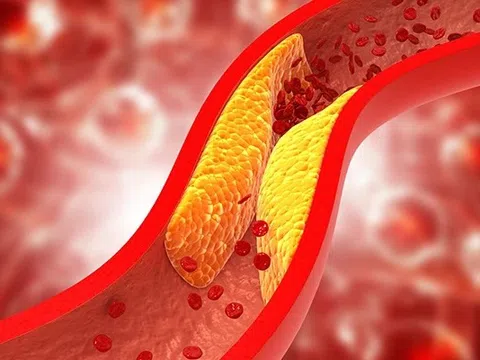 7 loại thực phẩm càng ăn mỡ máu càng giảm