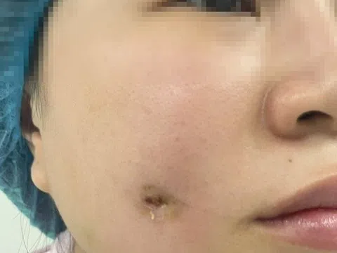 Người phụ nữ nhập viện sau khi làm đẹp tại spa