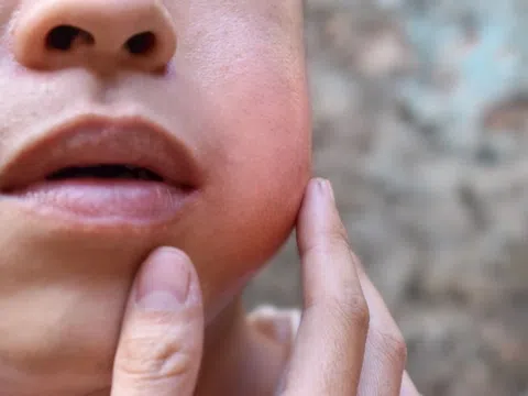 Một người có thể mắc quai bị hai lần không?