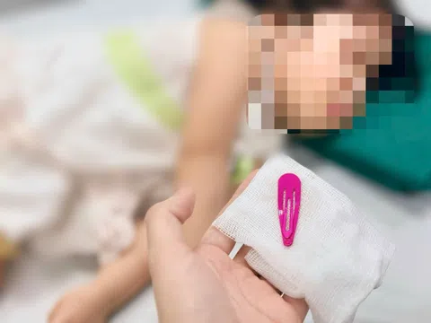 Bé 21 tháng tuổi phải nhập viện vì kẹp tóc nằm trong dạ dày