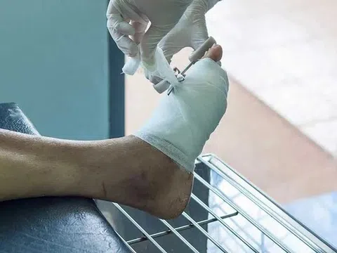 Một sai lầm nhỏ khiến cụ ông nhập viện với nguy cơ cắt cụt chân
