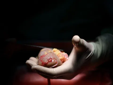 Quả thận của mẹ giữ con lại với đời