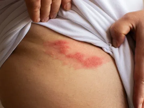 Bệnh giời leo có phải là zona thần kinh?