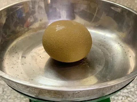 Lấy sỏi to như quả cam ra khỏi cơ thể người đàn ông