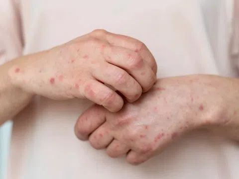 Triệu chứng dễ nhầm lẫn giữa sốt xuất huyết và bệnh sởi