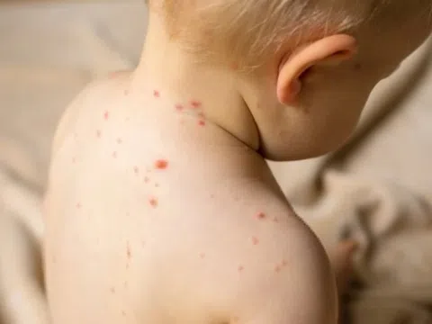 Điều tuyệt đối nên tránh khi bị sởi