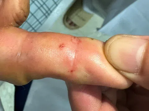 Thêm một người bị rắn hổ mang cắn