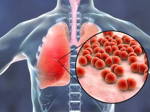 Cảnh báo phế cầu khuẩn gây viêm màng não, nhiễm trùng toàn thân