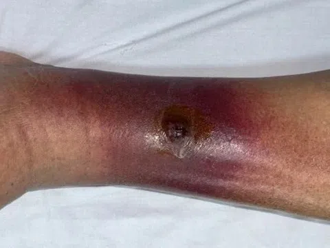 Mối nguy từ những vết trầy nhỏ